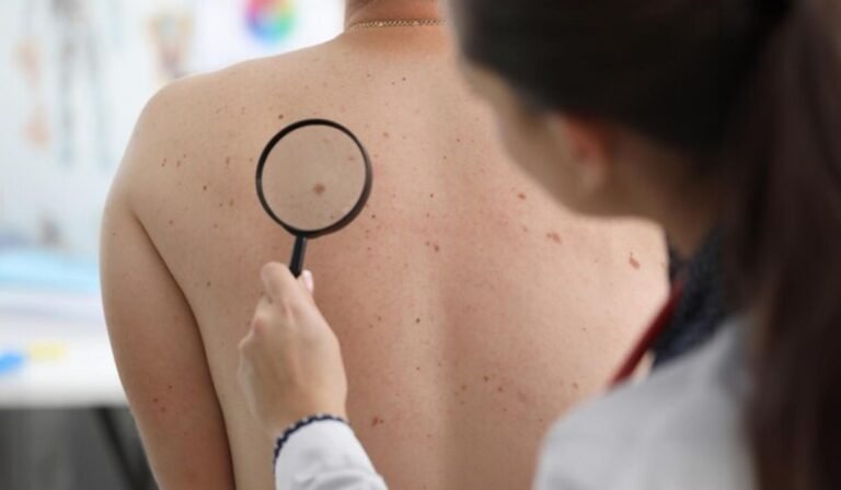 Tips for Identifying Skin Tags and Moles from a Skin Clinic in Hove